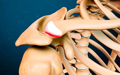 Артроз акромиально-ключичного сочленения