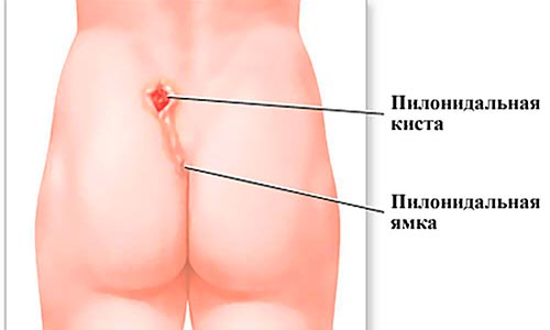Пилонидальная болезнь