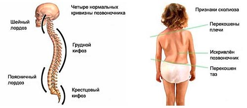 Симптомы нарушений осанки