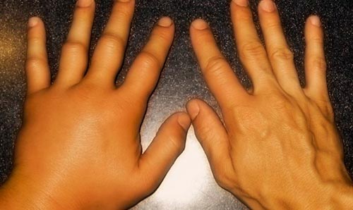 Болезнь Стилла у взрослых и детей – симптомы и лечение