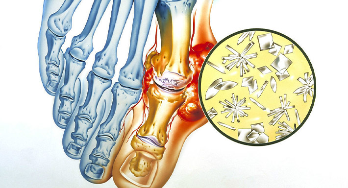 Как лечить подагру в домашних условиях: симптомы, народные рецепты
