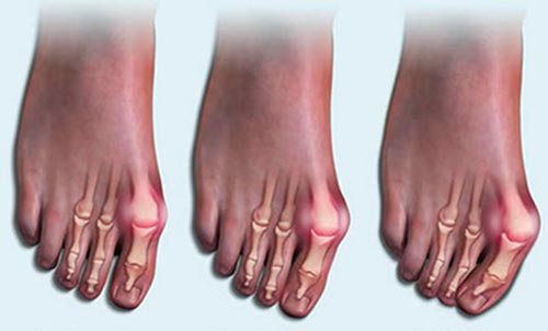Методы лечения артроза большого пальца и других пальцев ног