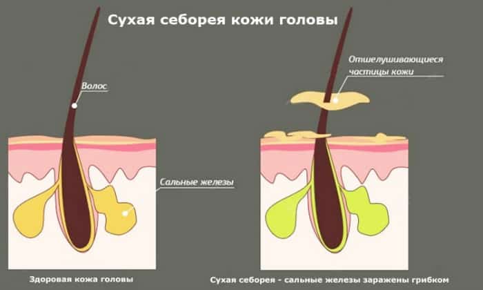 suhaya-seboreya-kozhi-golovy-2 Что такое себорея и как это лечить?