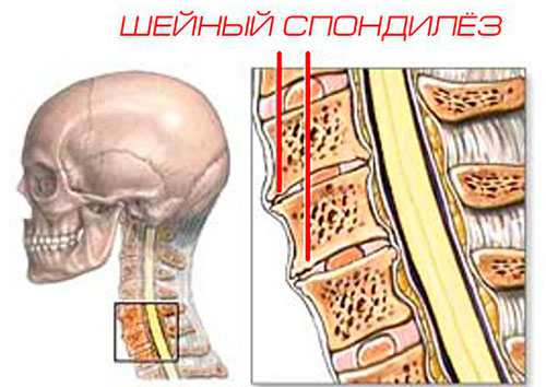 Причины развития деформирующего спондилеза