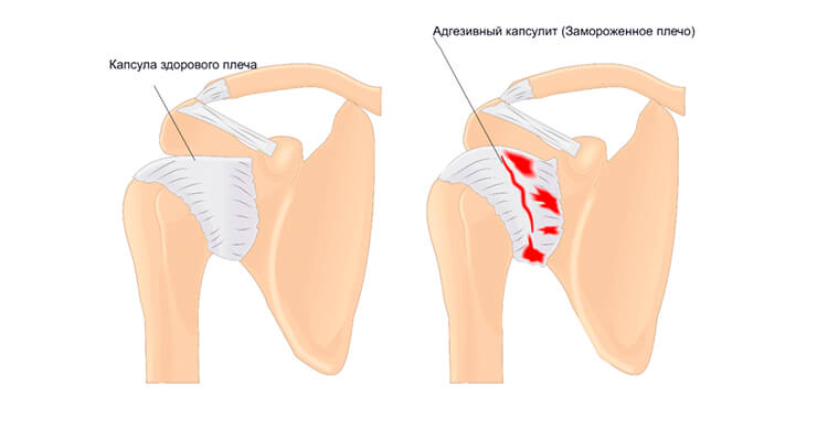 Капсулит Капсулит