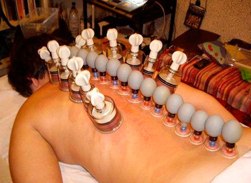 Как ставить банки при остеохондрозе?