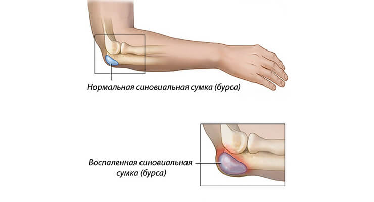 Виды бурсита Виды бурсита
