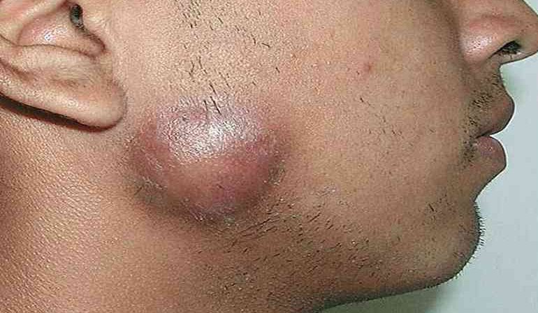 Донованоз — как побороть венерическую заезжую болячку?