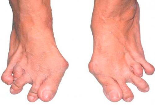 Виды артрита