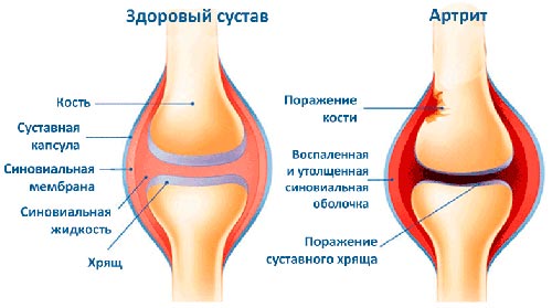 Артрит сустава