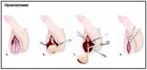 Как снять боль при раке простаты?