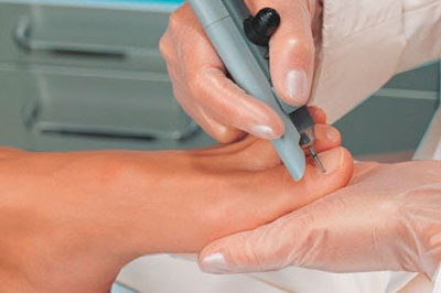 Процесс удаления ногтя Процесс удаления ногтя