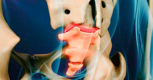 Загиб копчика - последствия