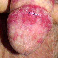 Красные пятна и точки на головке члена: отчего они появляются и как вылечиться?