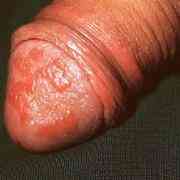 Красные пятна и точки на головке члена: отчего они появляются и как вылечиться?