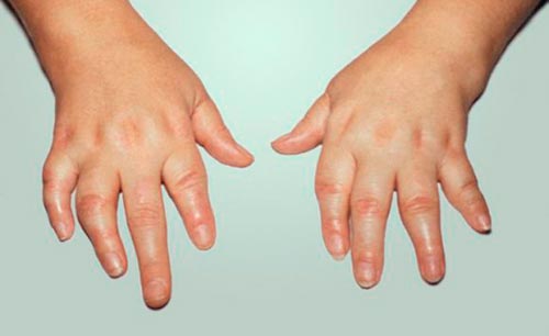 Артрит пальцев рук