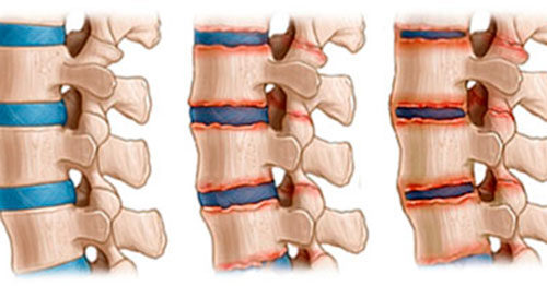 Стадии артрита позвоночника