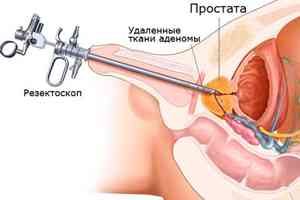 Как происходит удаление аденомы простаты через мочеиспускательный канал?