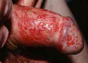 Красные пятна и точки на головке члена: отчего они появляются и как вылечиться?