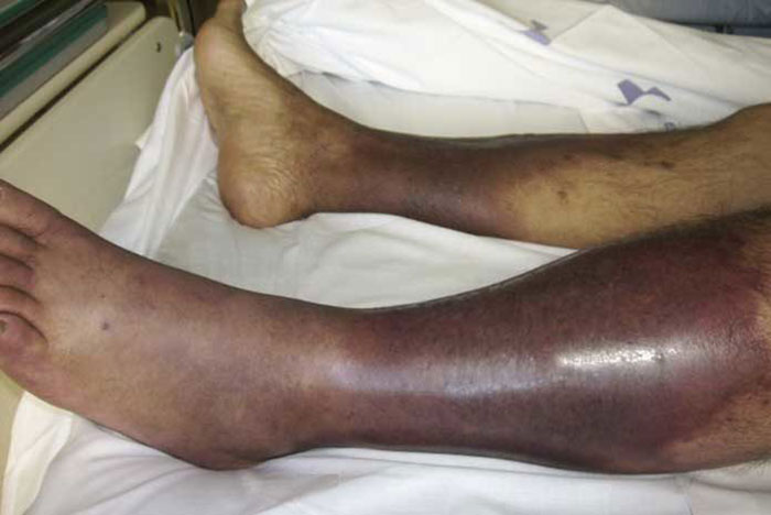 Различные инфекционные заболевания могут привести к отказу ног у алкашей