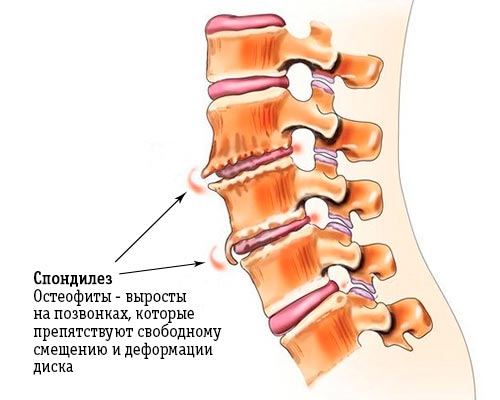 Что такое деформирующий спондилез?