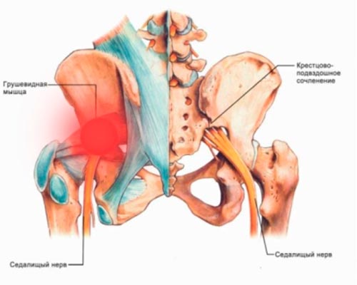 Синдром грушевидной мышцы