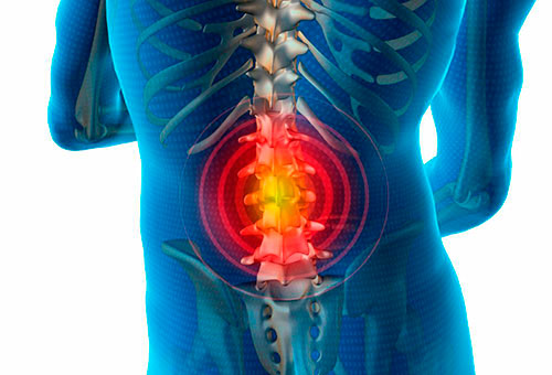 Классификация межпозвоночных грыж по расположению