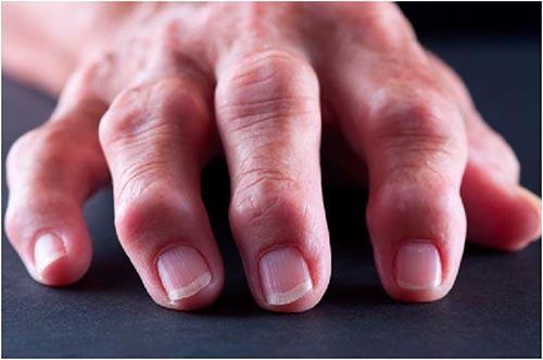 Артроз и артрит коленного сустава