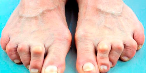 Артрит пальцев ног