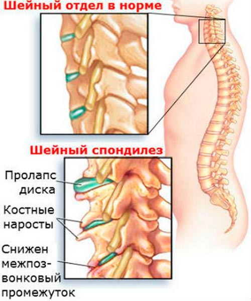 Спондилез шейного отдела позвоночника
