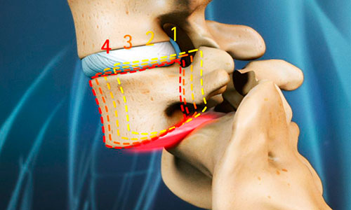 Как вправить позвонки при смещении самостоятельно?