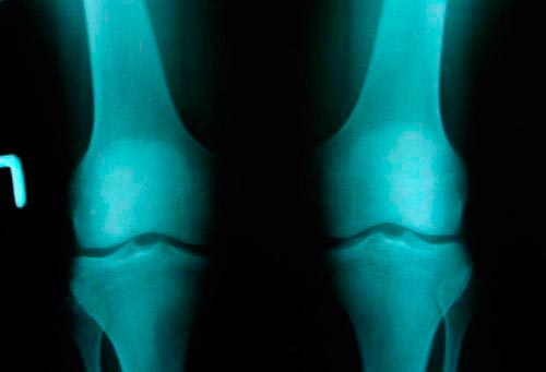 Рентген при артрозе