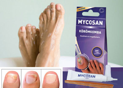 Результат применения средства от грибка Результат применения средства от грибка