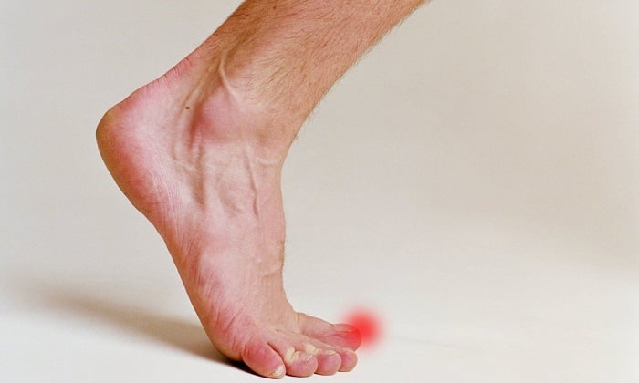 travma Диагностика и лечение микоза ногтей