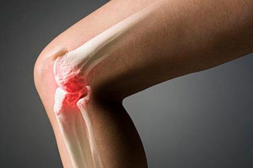 Гонартроз коленного сустава