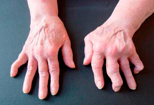 Артрит пальцев