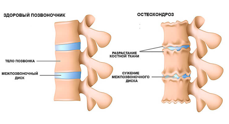 Остеохондроз позвоночника Остеохондроз позвоночника