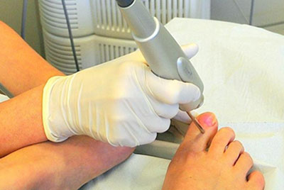 Лечение грибка лазером Лечение грибка лазером