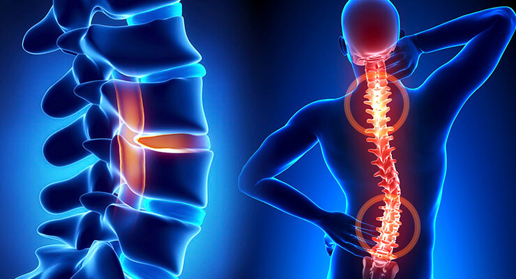 Боль под правой лопаткой – вертебрологические предпосылки Боль под правой лопаткой – вертебрологические предпосылки