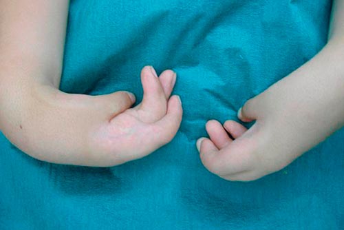 Заболевание артрогрипоз