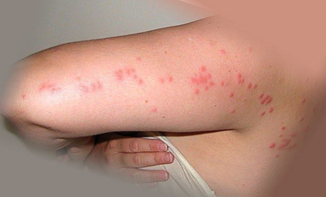 дорожка укусов клопов