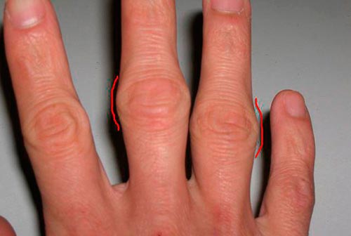 Отек пальцев рук