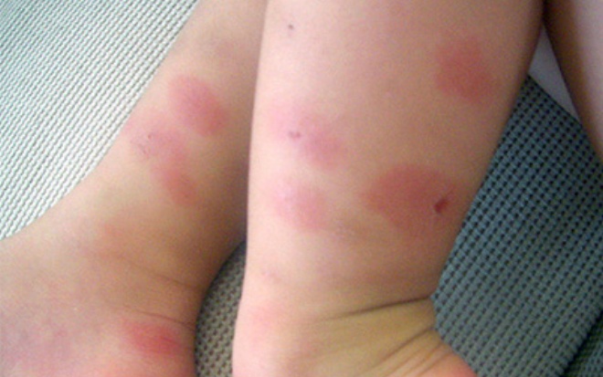 аллергия от укуса клопа