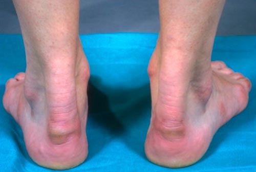 Лечение бурсита ахиллова сухожилия