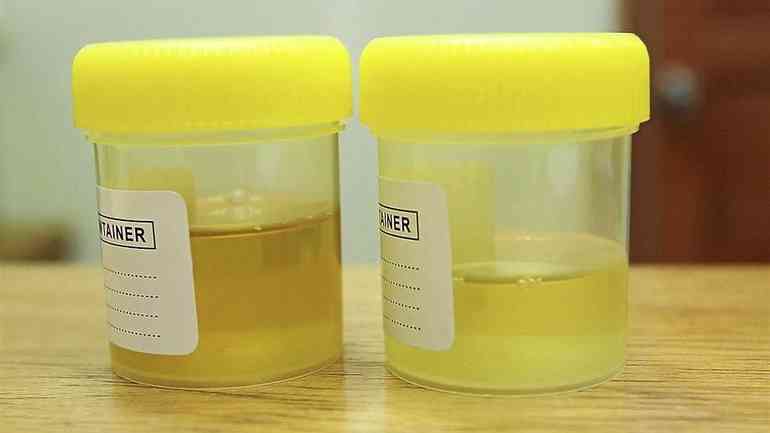 Как может выглядеть моча при простатите?