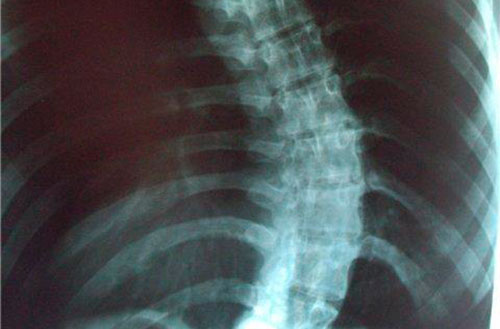 Искревление позвоночника - сколиоз