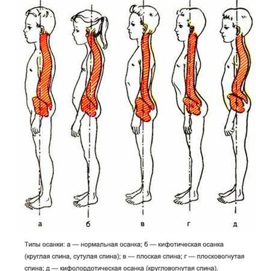 Классификация нарушений осанки у детей
