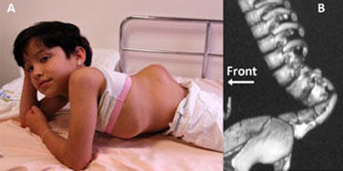 Миелодисплазия пояснично-крестцового отдела позвоночника