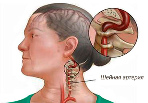 Причины вертеброгенного синдрома