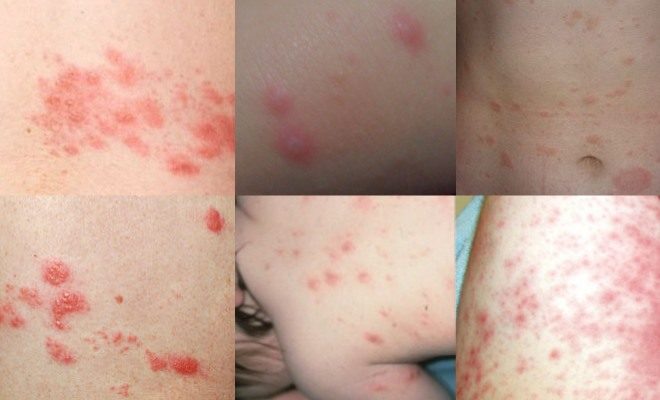 аллергии похожие на укусы